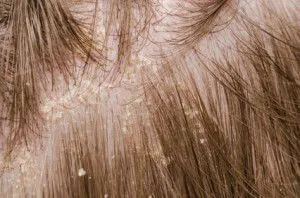 itchy head
