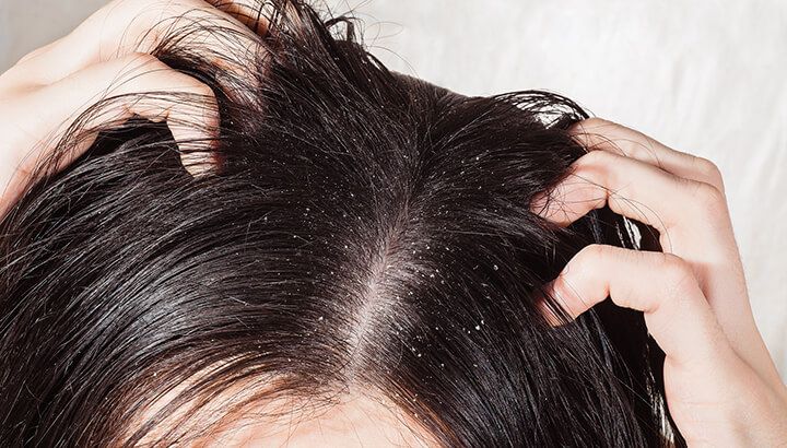 Castor Oil For Dandruff