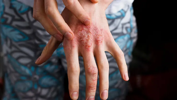 Emu oil is said to treat a range of conditions, including psoriasis.