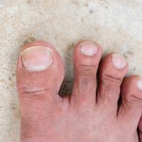 closeup nails having fungus