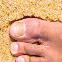 Ringworm. Mycosis to the toe. Beach sand background.