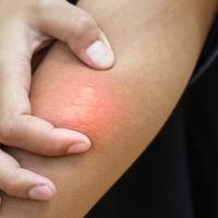 Close-up of bee sting stuck in human skin.